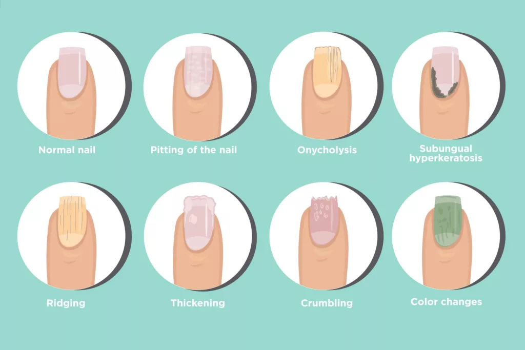 Common Nail Problems